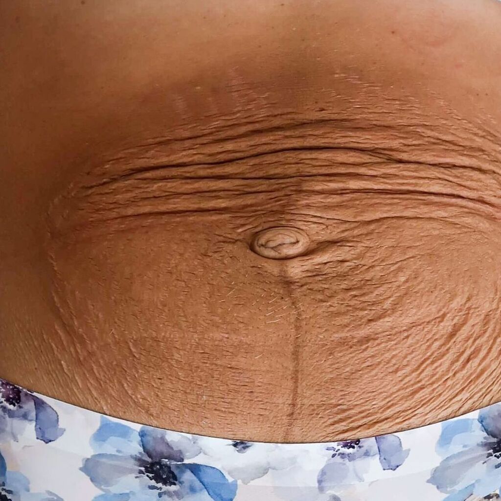 Πριν και μετά: Μαμά ποζάρει μετά τον τοκετό και στέλνει το δικό της μήνυμα