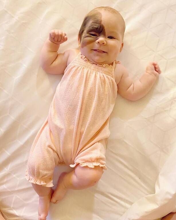  «Συγγενής Μελανοκυτταρικός Σπίλος» (CMN) - Η μικρή που τρέλανε το Instagram