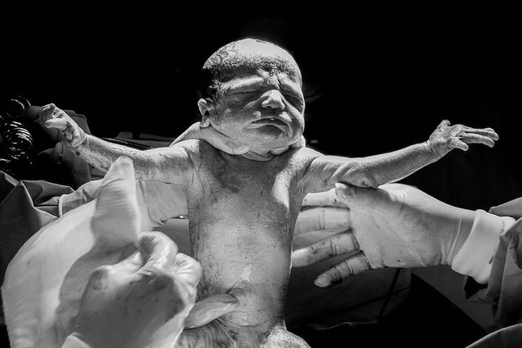 Τοκετός με καισαρική: Είναι εξίσου μοναδικός και αυτές οι φωτο το αποδεικνύουν