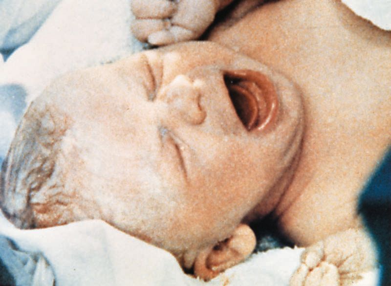 Το πρώτο «παιδί του σωλήνα» γεννήθηκε σαν σήμερα πριν 36 χρόνια!