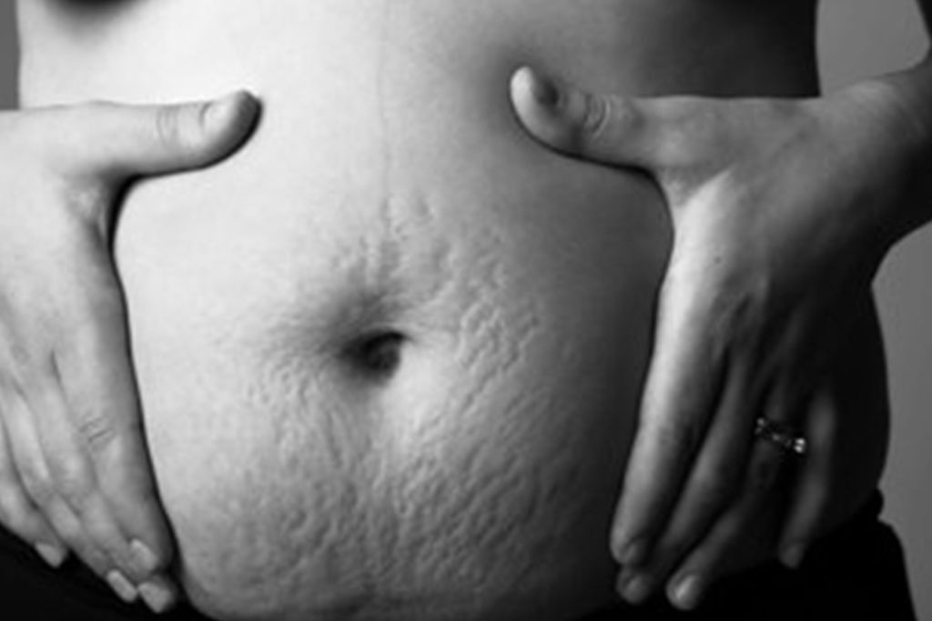 Το μεγαλείο της μητρότητας μέσα από φωτογραφίες που δείχνουν γυναικείο σώμα μετά τον τοκετό (pics)