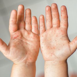 Πώς μεταδίδεται ο ιός κοξάκι, ποιοι είναι οι παράγοντες κινδύνου & φώτο να τον αναγνωρίσετε