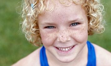 Οι φακίδες και πώς να τις καταπολεμήσετε!