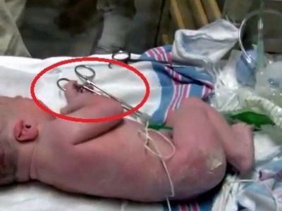 Απίστευτο βίντεο: Νεογέννητο βοηθά τον γιατρό να κόψει τον ομφάλιο λώρο!