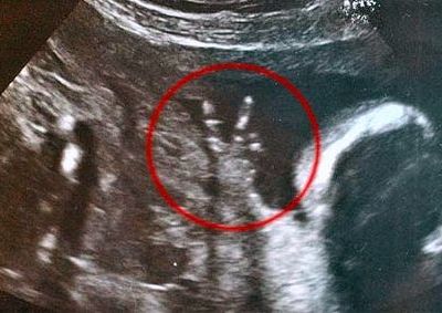 Απίστευτο: Έμβρυο από την κοιλιά της μάνας του κάνει το σήμα της νίκης με τα δαχτυλάκια του!