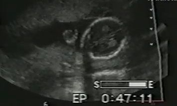 Βίντεο: Απίστευτο: Έμβρυο χαιρετάει από την κοιλιά της μητέρας του!