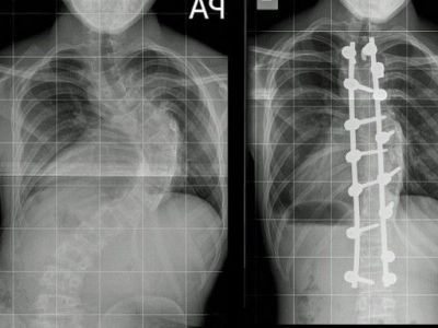 Έφηβος ψηλώνει κάθε βράδυ περίπου δύο πόντους μετά από εγχείρηση σκολίωσης!