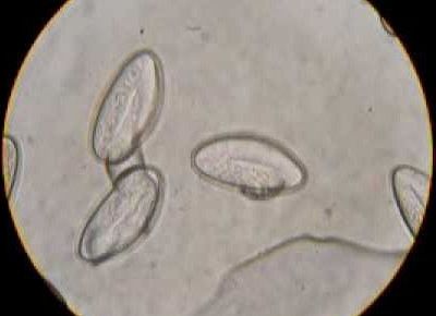 Οξύουροι στα παιδιά: Τι είναι και πώς αντιμετωπίζονται!