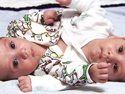 Τα σιαμαία που κέρδισαν τη ζωή και τώρα πηγαίνουν σχολείο! (φωτογραφίες)