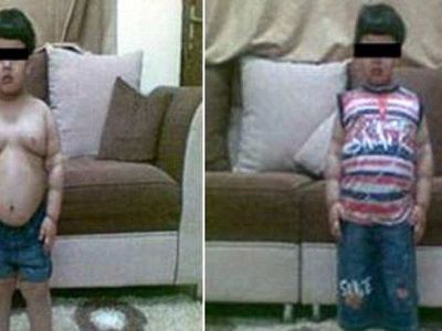 Η πρώτη γαστρεκτομή σε 2χρονο αγοράκι που κινδύνευε να πεθάνει από το πάχος του!