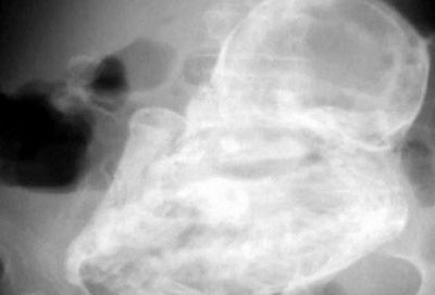 Απίστευτο! Μία 80χρονη είχε στην κοιλιά της έμβρυο … 40 ετών! (βίντεο)