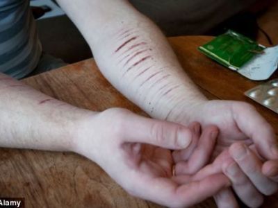 Η νέα τραγική μόδα των εφήβων: Τους αρέσει να αυτοτραυματίζονται! (εικόνες)