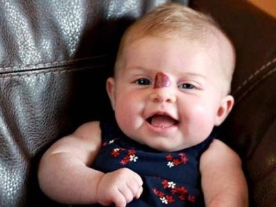 Αιμαγγειώματα: Τι είναι και πώς θεραπεύονται;