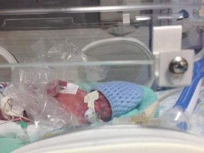 Τα πρόωρα διδυμάκια που σώθηκαν χάρη στα πλαστικά σακουλάκια τροφίμων! (εικόνες)