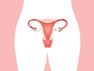 Ποιες είναι οι πιθανές επιπλοκές της ενδομητρίωσης