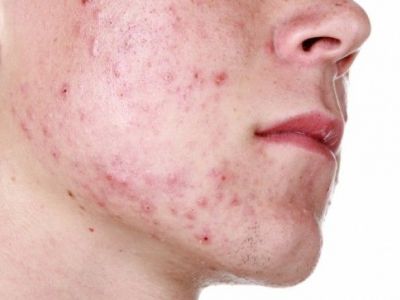 Κυστική ακμή: Πώς αντιμετωπίζεται η πιο δύσκολη μορφή ακμής