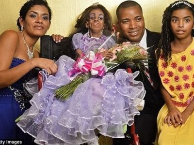 Κολομβιανή έφηβη γιόρτασε τα 15α γενέθλιά της αν και πάσχει από προγηρία