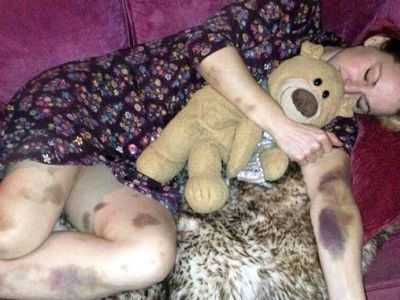 Ξύπνησε και είδε το σώμα της καλυμμένο με μελανιές. Ο λόγος; Τρομακτικός!