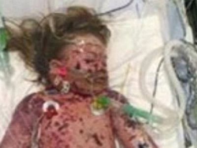 Γονείς έχασαν το 2χρονο κοριτσάκι τους από μηνιγγίτιδα Β και δημοσίευσαν αυτή τη σοκαριστική φωτό. Δείτε γιατί