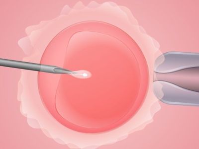 Προκαλεί η εξωσωματική καρκίνο του μαστού; Ποια είναι τα νεώτερα ευρήματα