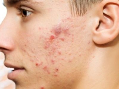 Γιατί τα αγόρια έχουν ακμή;