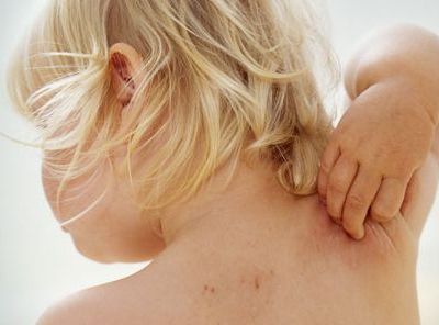 Ατοπική δερματίτιδα: Τι πρέπει να γνωρίζετε για να μην ταλαιπωρείται το παιδί σας