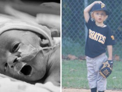 Το θαύμα της ζωής: Φωτογραφίες πρόωρων μωρών όταν γεννήθηκαν και σήμερα που μεγάλωσαν