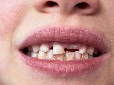 Παιδικά δόντια που αργούν να πέσουν - Τι πρέπει να γνωρίζουν οι γονείς