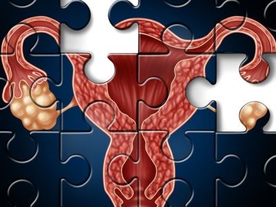 Σύνδρομο πολυκυστικών ωοθηκών: Πού οφείλεται η βασική αιτία της γυναικείας υπογονιμότητας