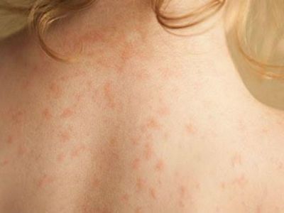 Μηνιγγίτιδα Β: Όλα όσα πρέπει να ξέρεις για τη νόσο