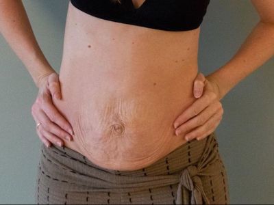 Μαμά δείχνει πώς είναι η κοιλιά της 16, 5 μήνες μετά τη γέννα και στέλνει το δικό της μήνυμα (pics)