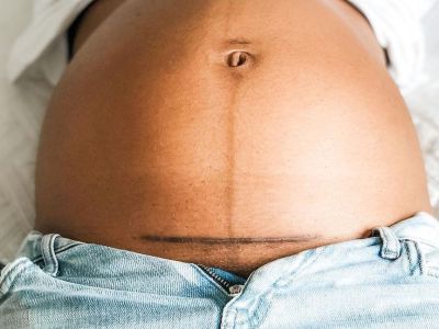 Αυτό το σημάδι της καισαρικής τομής είναι κάτι περισσότερο από μια ουλή