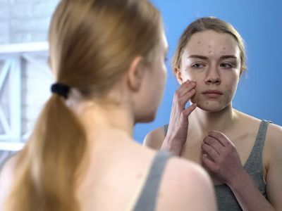 Ακμή εφήβων: Χρήσιμες συμβουλές για την αντιμετώπισή της