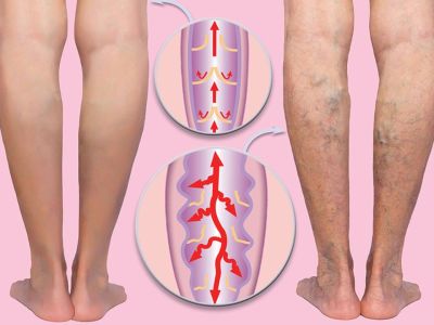 Οι τροφές που προστατεύουν τις φλέβες και τις αρτηρίες (εικόνες)