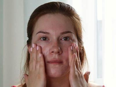 Σύνδρομο Sjögren - Αίτια, συμπτώματα, θεραπεία, αντιμετώπιση, κίνδυνοι