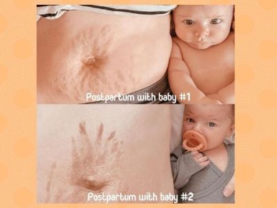 Αυτά τα σημάδια θα μείνουν για πάντα μαζί μου