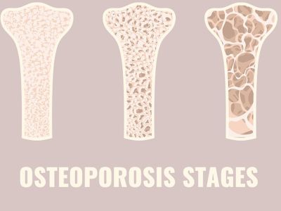 Μέτρηση οστικής πυκνότητας: Ποιοι και πότε πρέπει να κάνουν την εξέταση (εικόνες)