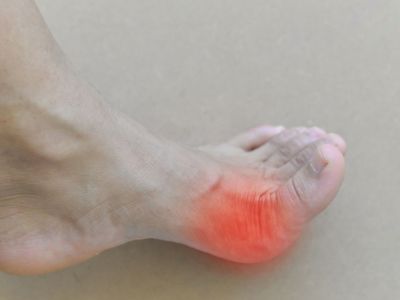 Υψηλό ουρικό οξύ: Πώς θα προλάβετε τα επεισόδια ουρικής αρθρίτιδας φυσικά (εικόνες)