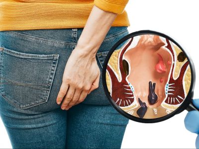 Αιμορροΐδοπάθεια: Ποιοι κινδυνεύουν περισσότερο (εικόνες)