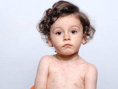 Βρεφική ροδάνθη: Αίτια, συμπτώματα και αντιμετώπιση