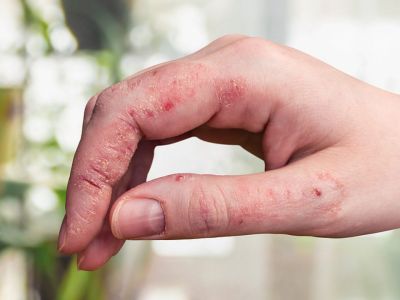 Ψωρίαση: Για ποιες μορφές καρκίνου αυξάνει τον κίνδυνο (εικόνες)