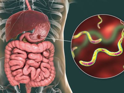 Γαστρικό έλκος: Αναγνωρίστε το από τα συμπτώματα (εικόνες)