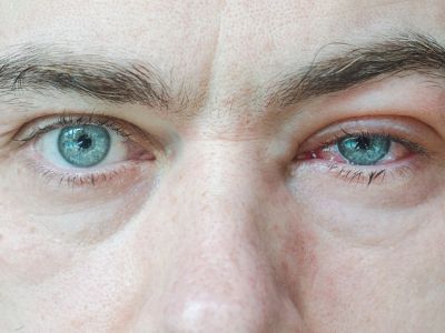 Πρήξιμο ματιών: Πού μπορεί να οφείλεται (εικόνες)