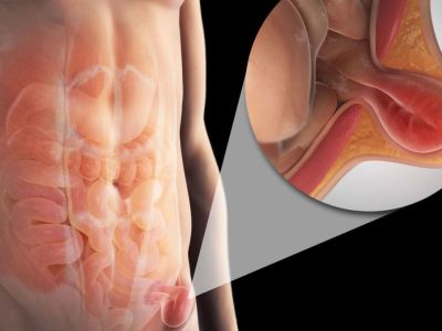 Βουβωνοκήλη: Τι είναι και από τι μπορεί να προκληθεί (εικόνες)