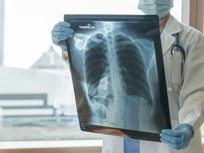 Κυστική ίνωση: Τι πρέπει να περιλαμβάνει η διατροφή των πασχόντων (εικόνες)