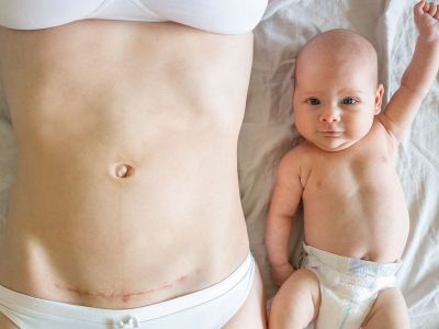 "Η καισαρική τομή δεν είναι ο εύκολος δρόμος"