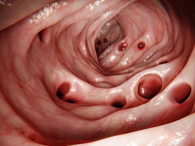 Εκκολπωματίτιδα: Οι παράγοντες που αυξάνουν τον κίνδυνο (εικόνες)