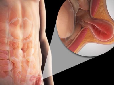 Κήλη: Πρόληψη και αντιμετώπιση (εικόνες)