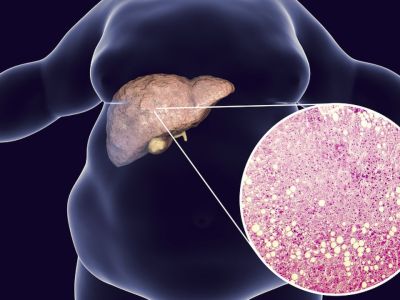 Οι επιπτώσεις της παχυσαρκίας στο πεπτικό (εικόνες)