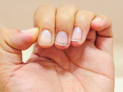 Διαταραχές νυχιών: Τι αποκαλύπτουν για την υγεία (εικόνες)